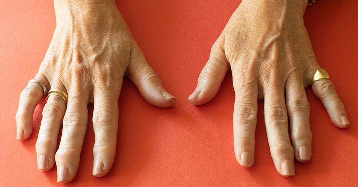 arthritis of the hands